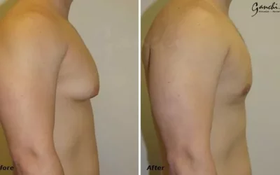 The Psychology of Gynecomastia: To Operate or Not To Operate on Man Boobs