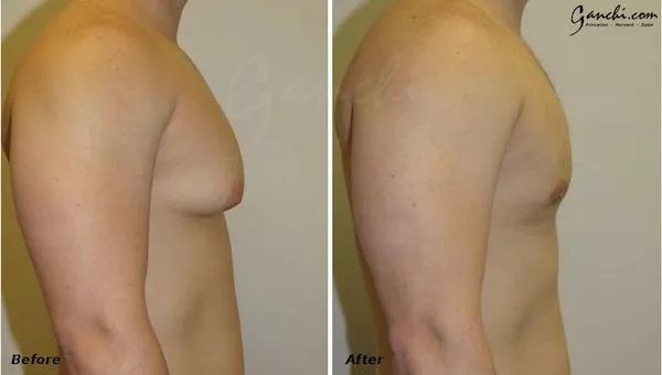 Gynecomastia Before and After Photo by Ganchi Plastic Surgery in Northern New Jersey