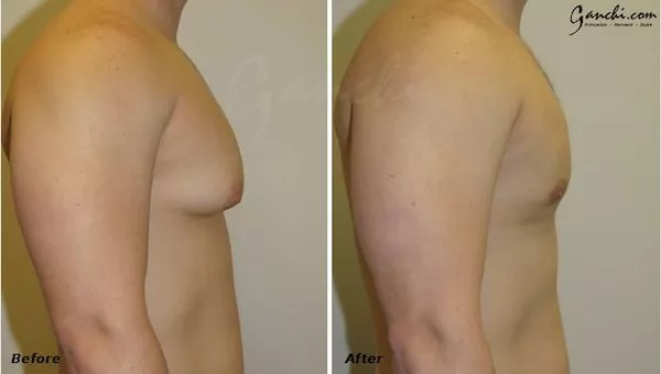 The Psychology of Gynecomastia  Ganchi Plastic Surgery Wayne, NJ