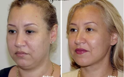Liposuction of the Neck and Chin