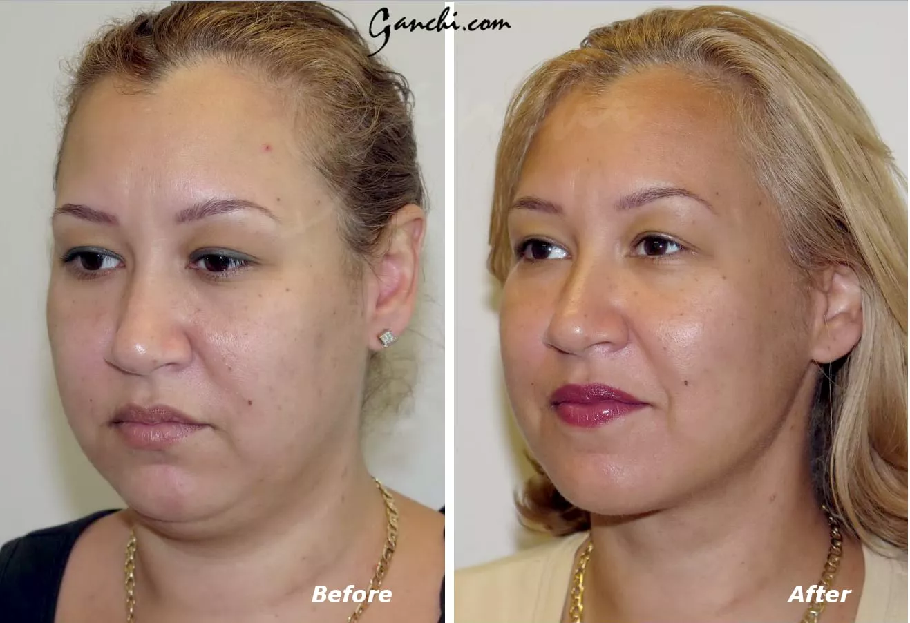 Liposuction of the Neck and Chin Before and After Photo by Ganchi Plastic Surgery in Northern New Jersey