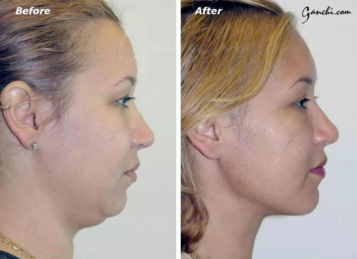 Neck Chin Liposuction Before and After Photo by Ganchi Plastic Surgery in Northern New Jersey