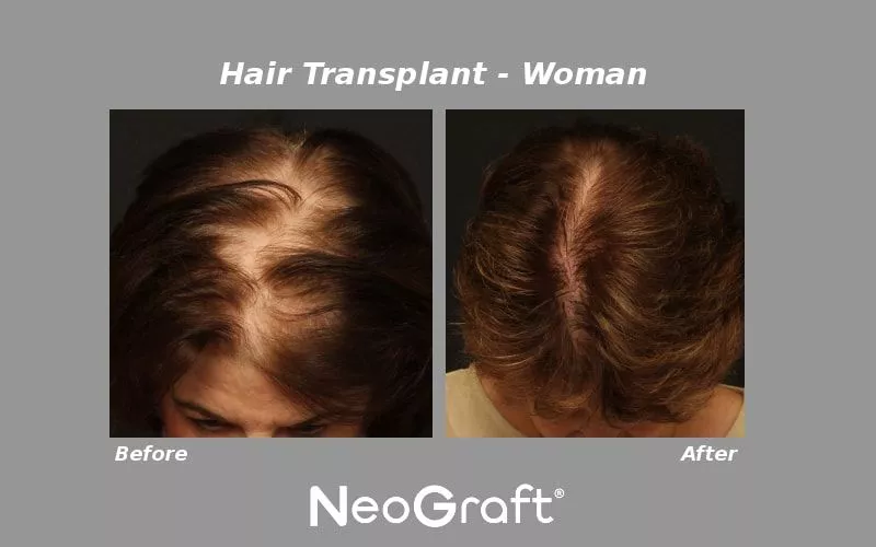 NeoGraft - Female Before and After Photo
