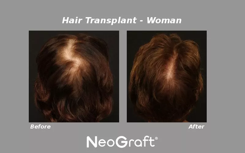 NeoGraft Female Before and After Photo