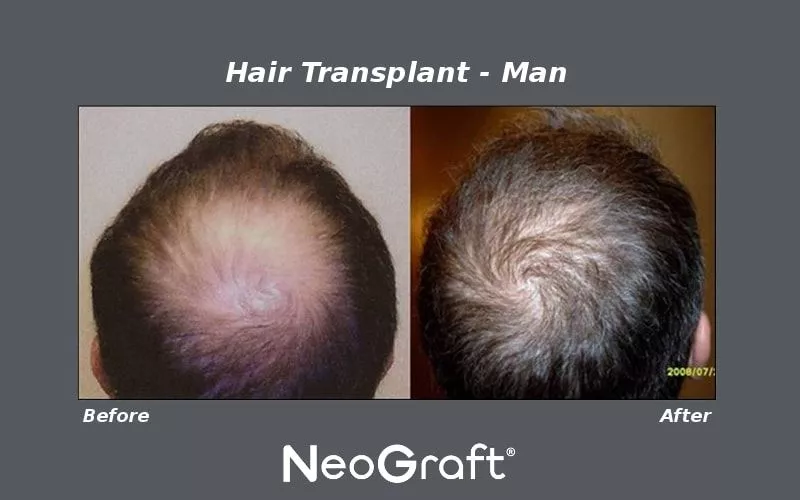 NeoGraft Hair Transplant Before and After Photo by Ganchi Plastic Surgery in Northern New Jersey
