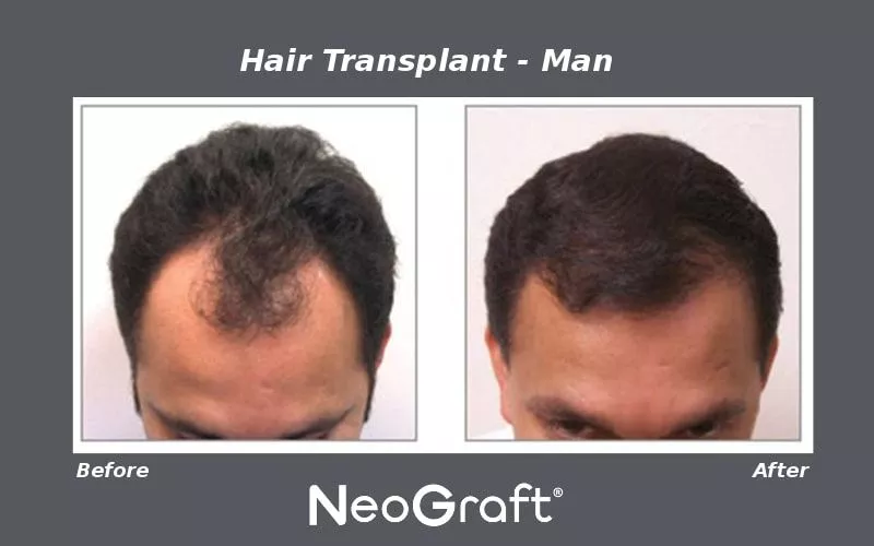 NeoGraft Male Before and After Photo by Ganchi Plastic Surgery in Northern New Jersey