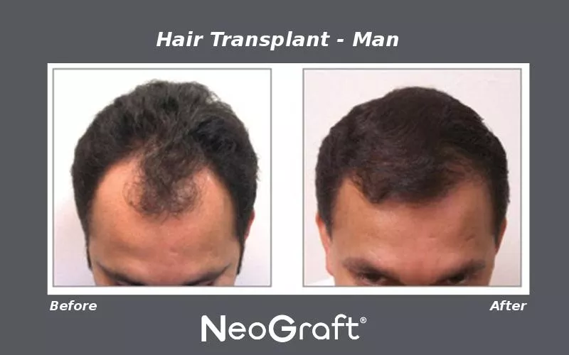 NeoGraft - Male Before and After NeoGraft - Male Before and After