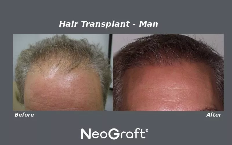 NeoGraft - Male Before and After Photos