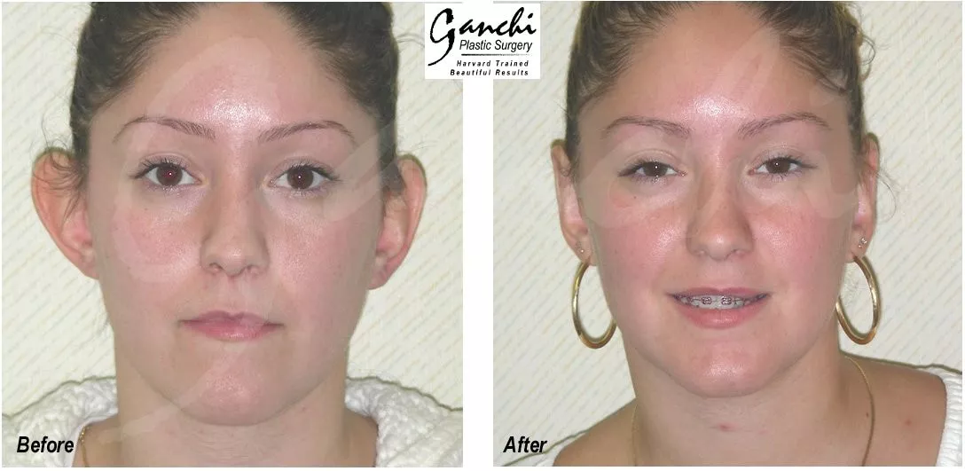 Otoplasty Before and After Photo by Ganchi Plastic Surgery in Northern New Jersey