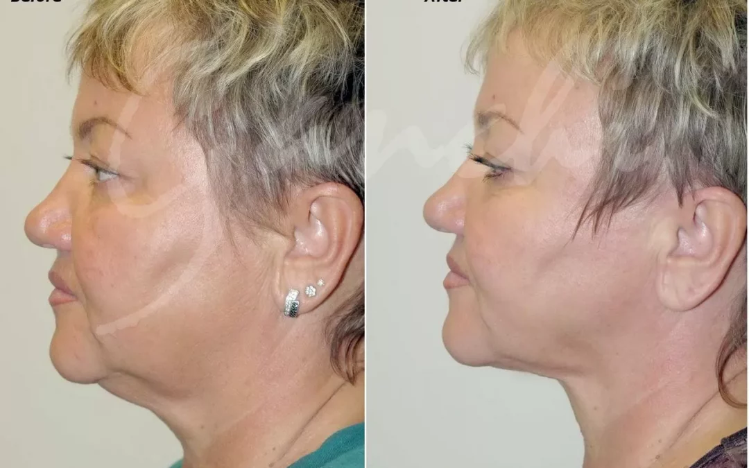 Laser Neck Lift With PrecisionTX
