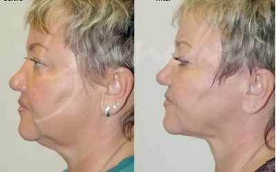 Laser Neck Lift With PrecisionTX