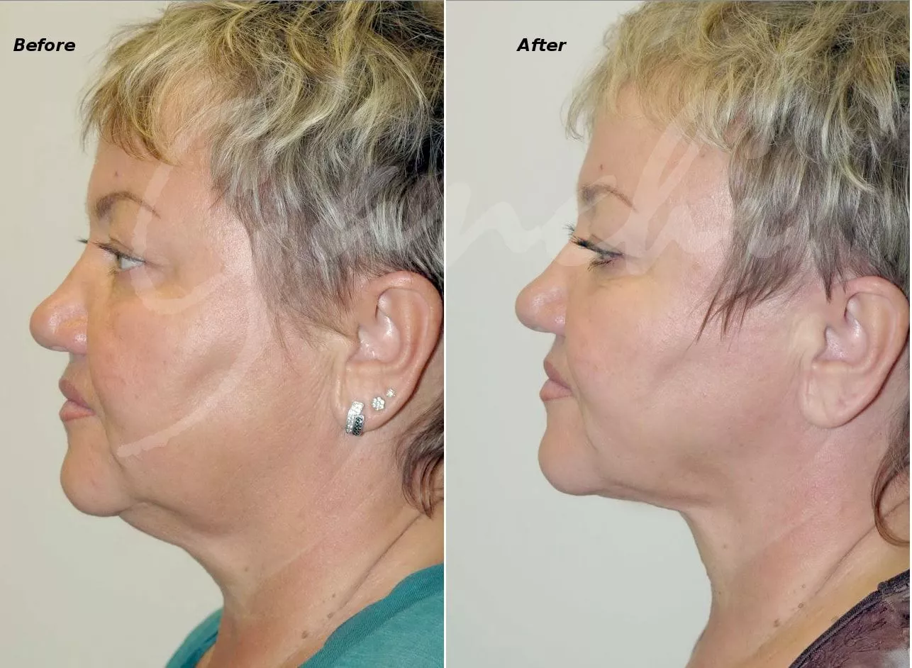 PrecisionTX neck jawline Before and After Photo by Ganchi Plastic Surgery in Northern New Jersey