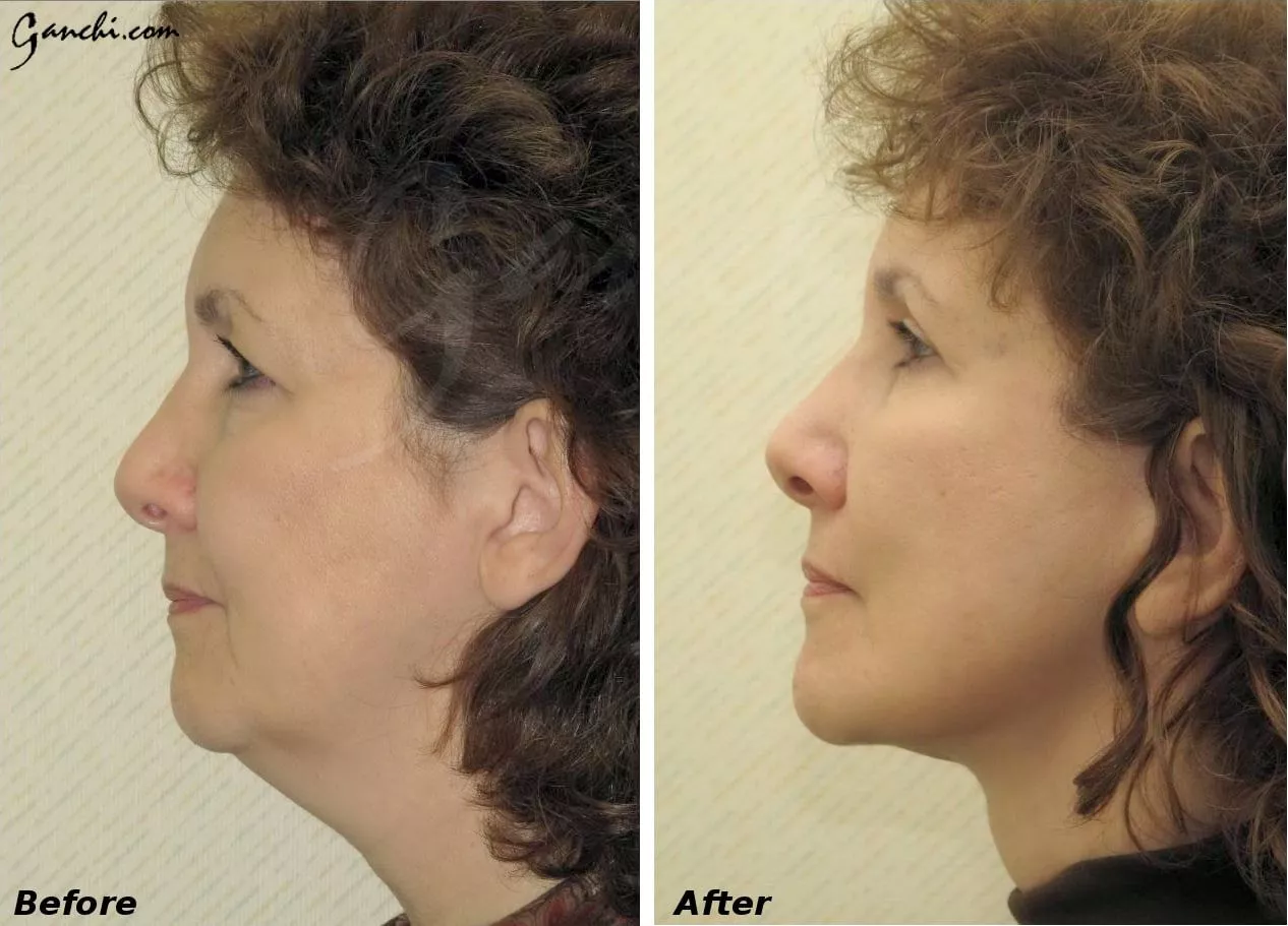 Neck and Facelift Before and After Photo by Ganchi Plastic Surgery in Northern New Jersey