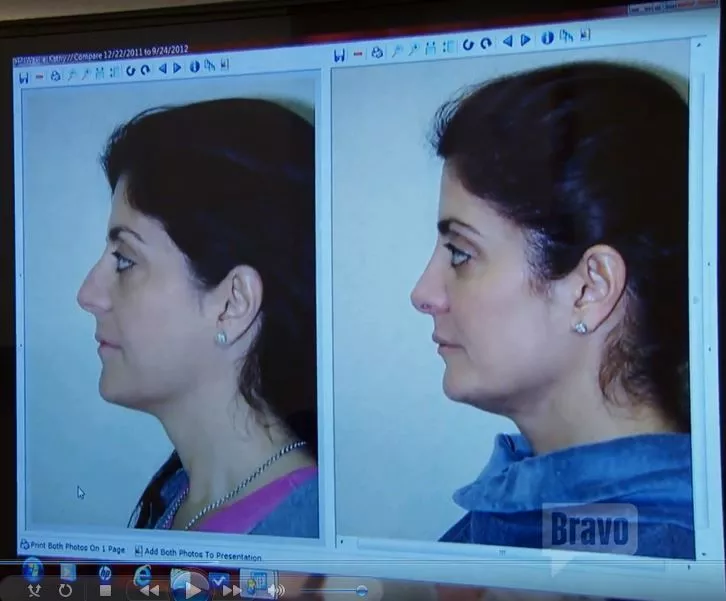 RHONJ Before-After Rhinoplasty