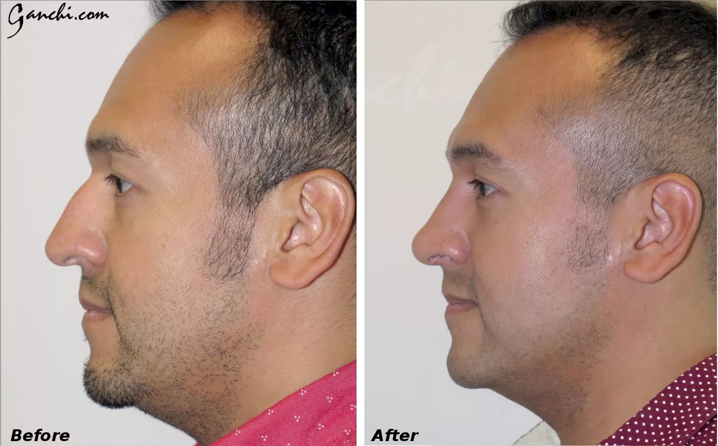 Male celebrity nose job Before and After Photo by Ganchi Plastic Surgery in Northern New Jersey