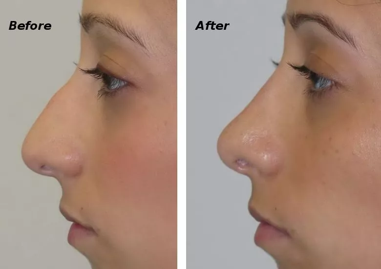 Rhinoplasty (nose job) Before and After Photo by Ganchi Plastic Surgery in Northern New Jersey