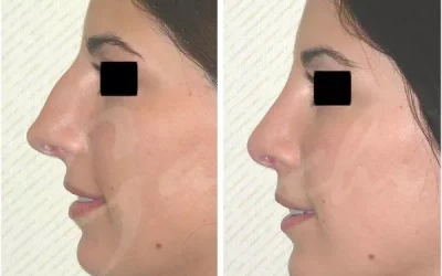 Rhinoplasty – Nose Surgery in New Jersey