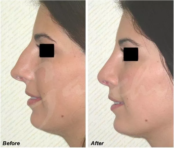 Rhinoplasty Before and After Photo by Ganchi Plastic Surgery in Northern New Jersey