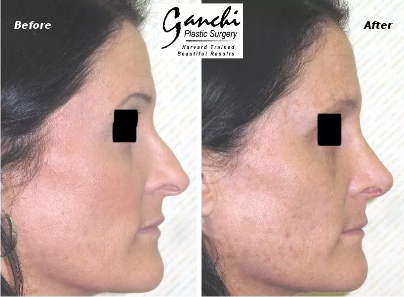 Rhinoplasty (nose job) Before and After Photo by Ganchi Plastic Surgery in Northern New Jersey
