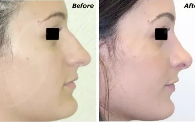Rhinoplasty For A More Beautiful Face