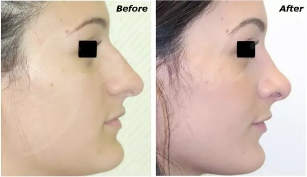 Rhinoplasty For A More Beautiful Face