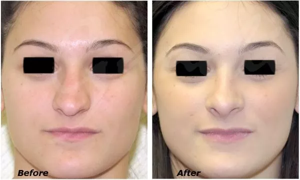 Rhinoplasty Before and After Photo by Ganchi Plastic Surgery in Northern New Jersey