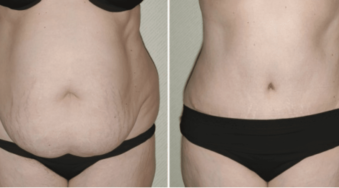 Best Tummy Tuck for Your Body