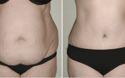 Best Tummy Tuck for Your Body