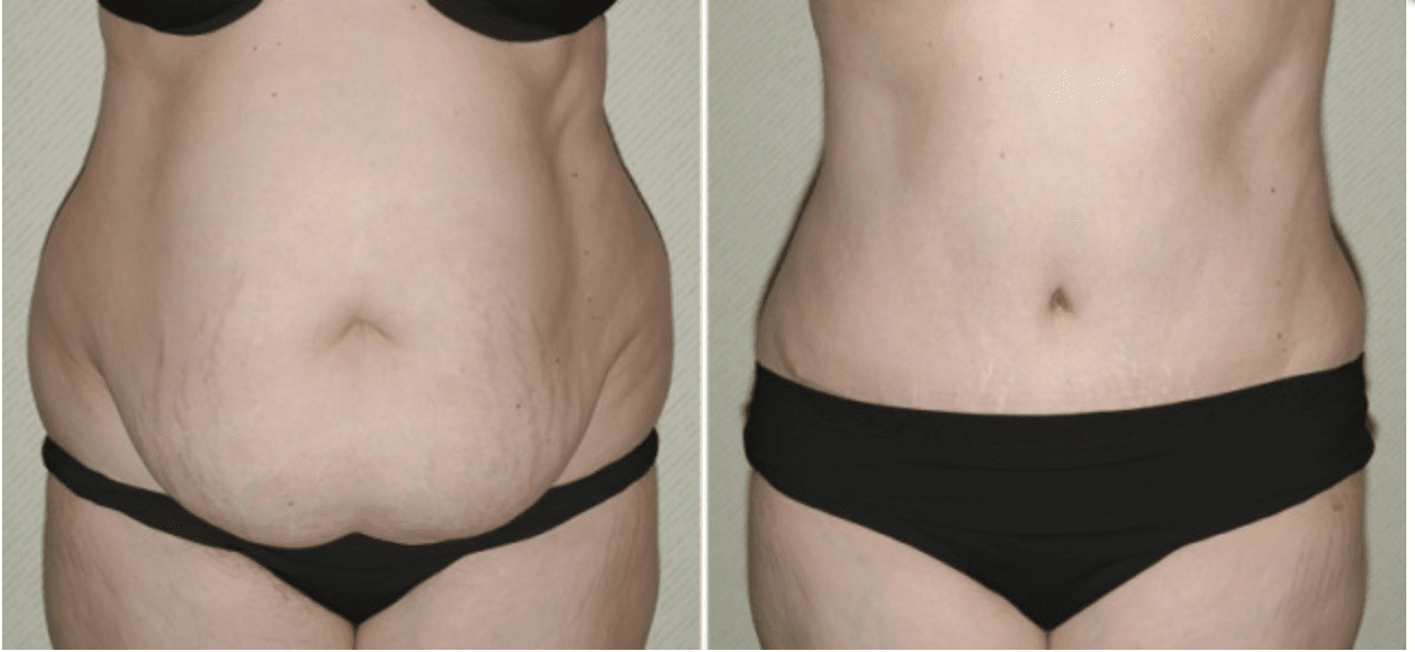 What is a Reverse Tummy Tuck