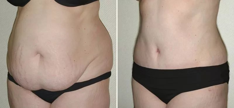 Abdominoplasty Before and After Photo by Ganchi Plastic Surgery in Northern New Jersey