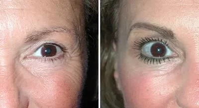 The Cosmetic Uses of Botox