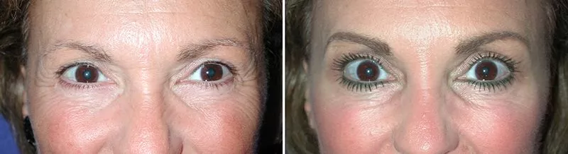 Crows feet wrinkles Before and After Photo by Ganchi Plastic Surgery in Northern New Jersey