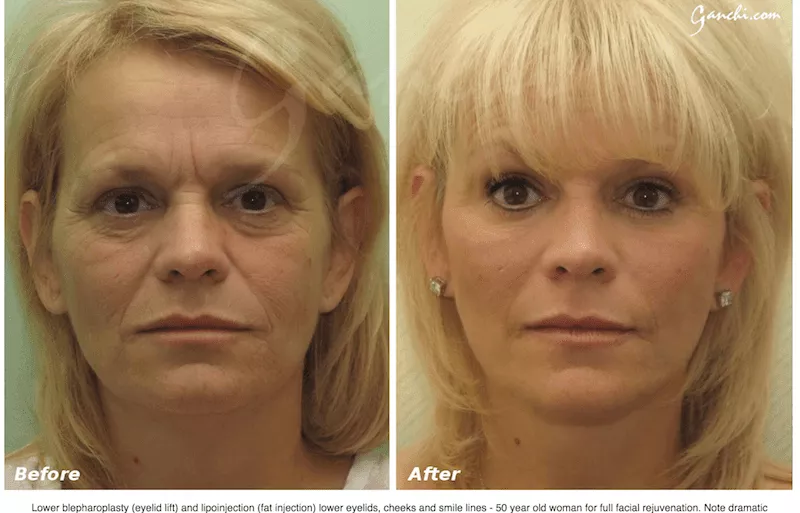 Eyelid Lift Surgery Before and After Photo by Ganchi Plastic Surgery in Northern New Jersey