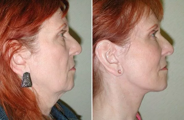 Facelift – Neck lift – Eyelid lift Before and After Photo by Ganchi Plastic Surgery in Northern New Jersey