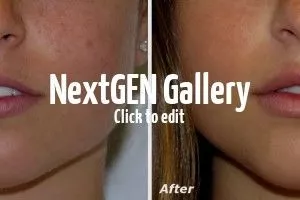Lip augmentation Before and After Gallery by Ganchi Plastic Surgery in Northern New Jersey