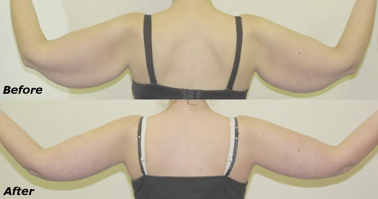 Arm Lift Before and After Photo by Ganchi Plastic Surgery in Northern New Jersey