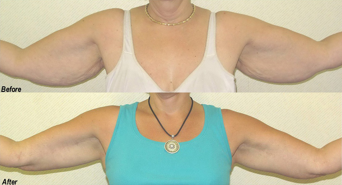 Arm Lift Before and After Photo by Ganchi Plastic Surgery in Northern New Jersey