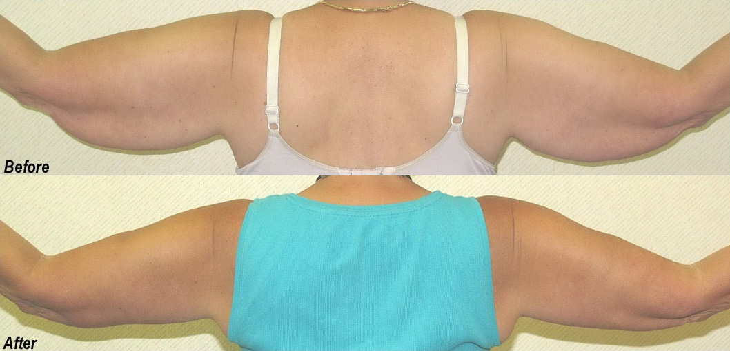 Arm Lift Before and After Photo by Ganchi Plastic Surgery in Northern New Jersey