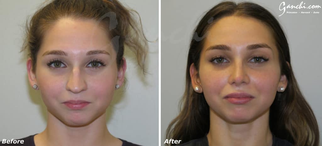Rhinoplasty Before and After Photo by Ganchi Plastic Surgery in Northern New Jersey