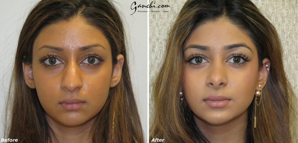 Rhinoplasty Before and After Photo by Ganchi Plastic Surgery in Northern New Jersey