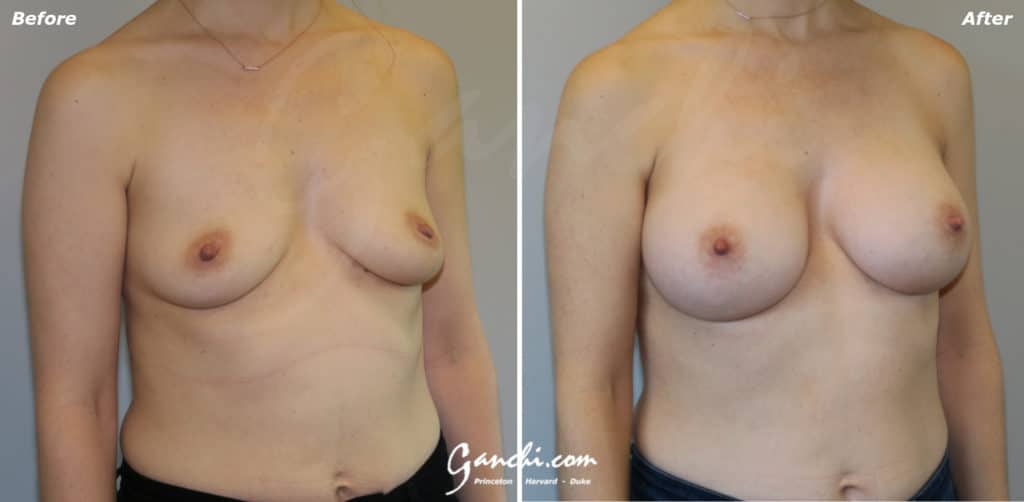 Breast Augmentation Before and After Photo by Ganchi Plastic Surgery in Northern New Jersey