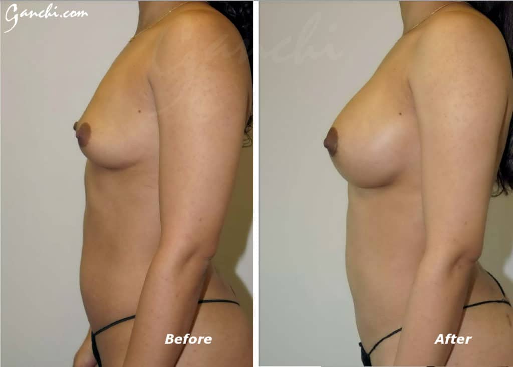 Breast Augmentation Before and After Photo by Ganchi Plastic Surgery in Northern New Jersey