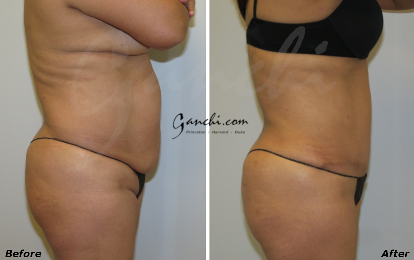 Abdominoplasty (Tummy Tuck) Before and After Photo by Ganchi Plastic Surgery in Northern New Jersey