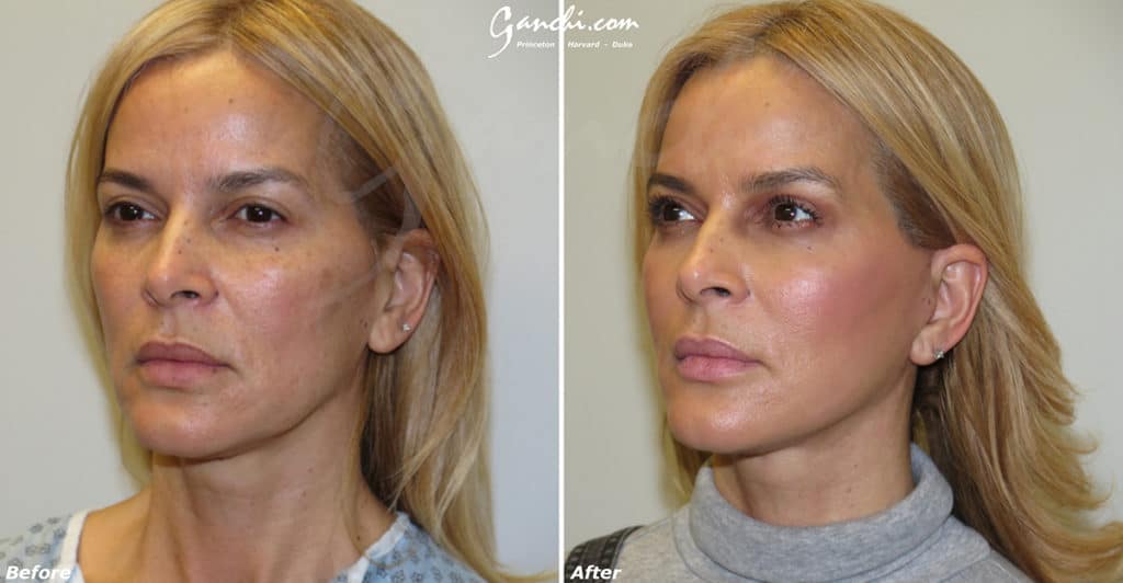 Facelift Before and After Photo by Ganchi Plastic Surgery in Northern New Jersey