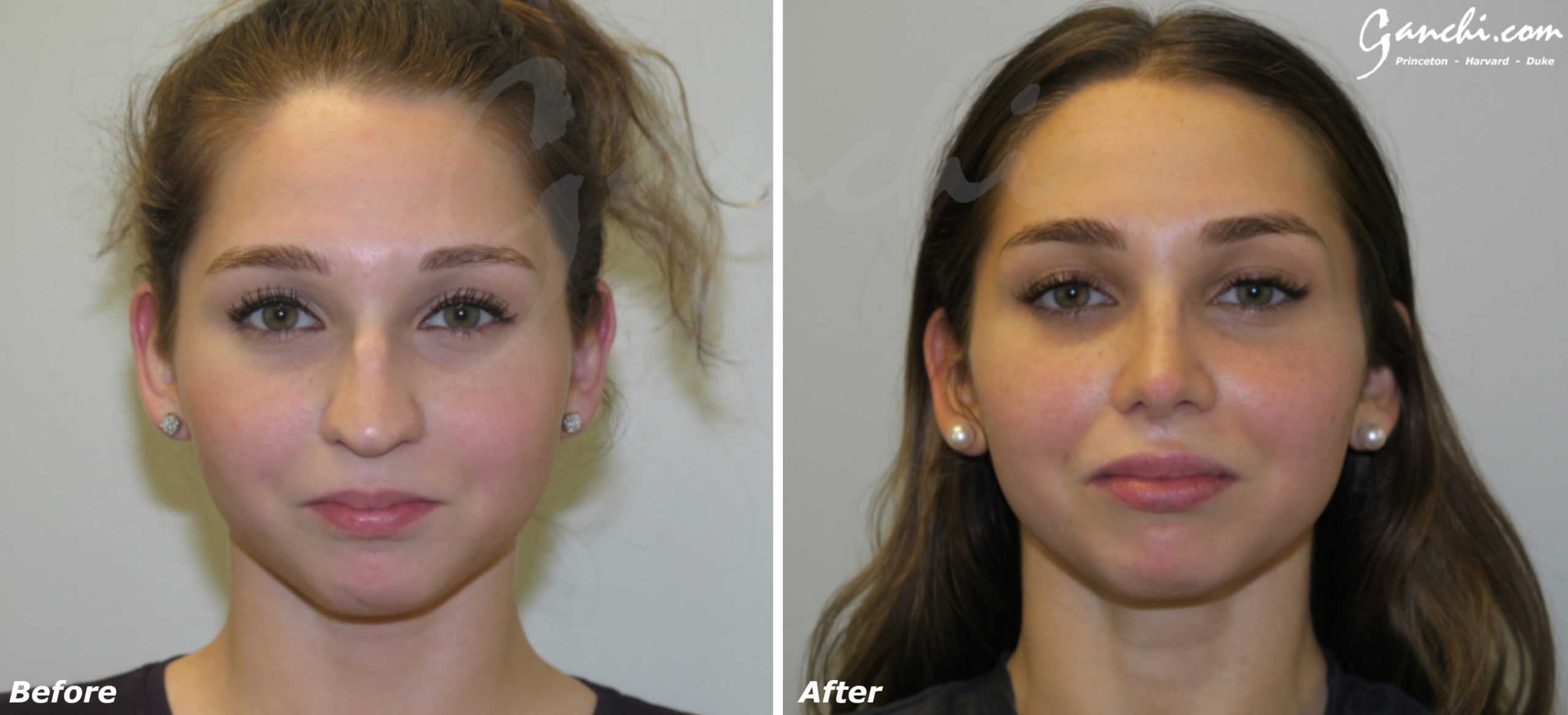 Rhinoplasty Before and After Results