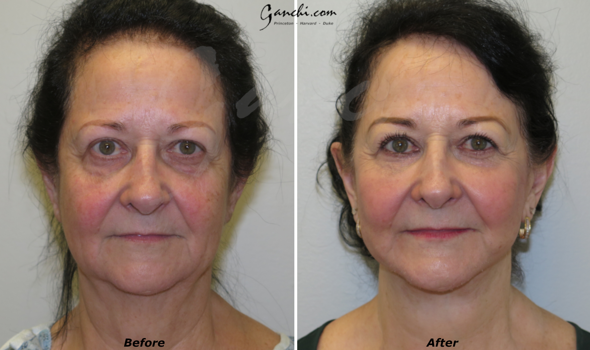 Facelift Before and After Results