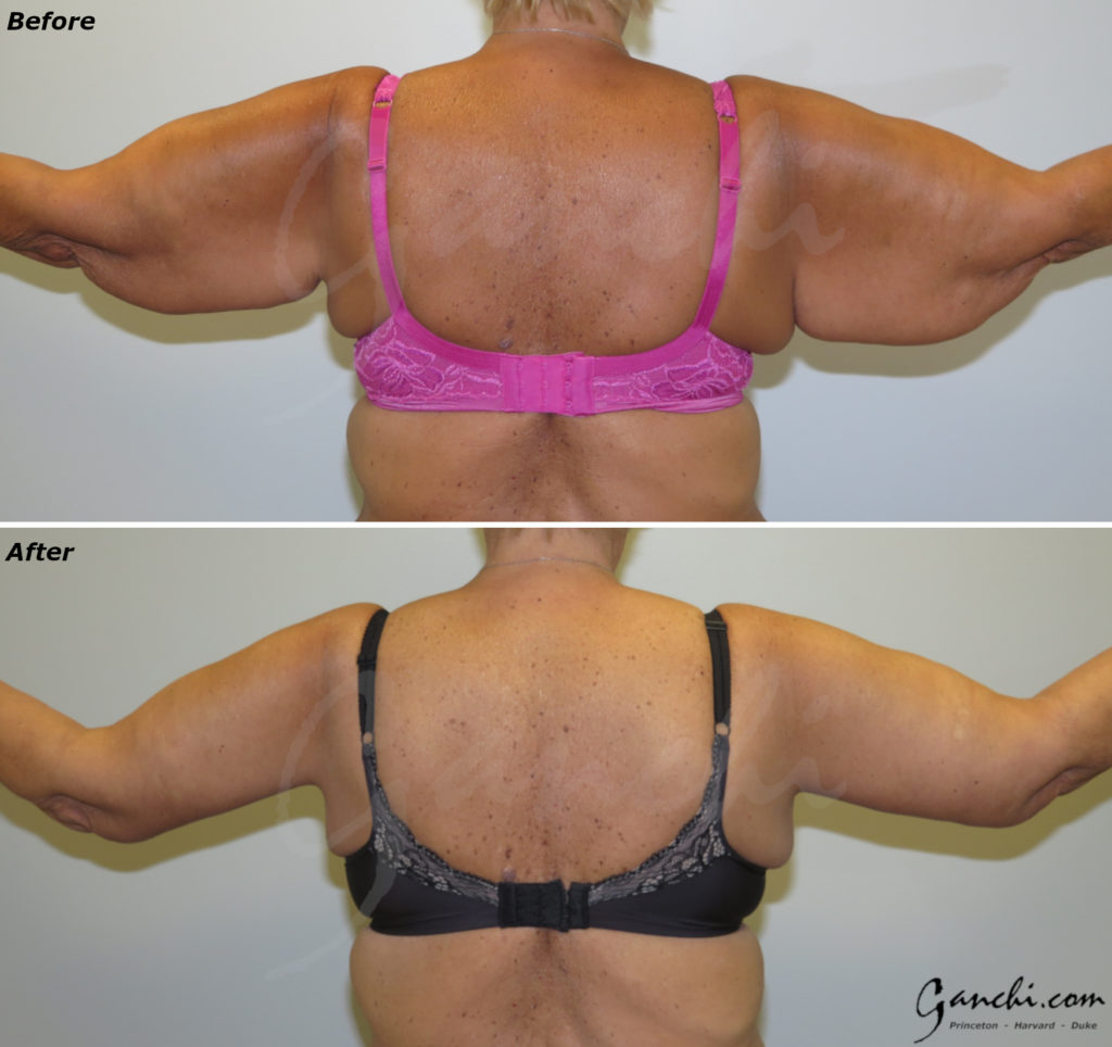 Arm Lift Before and After Results