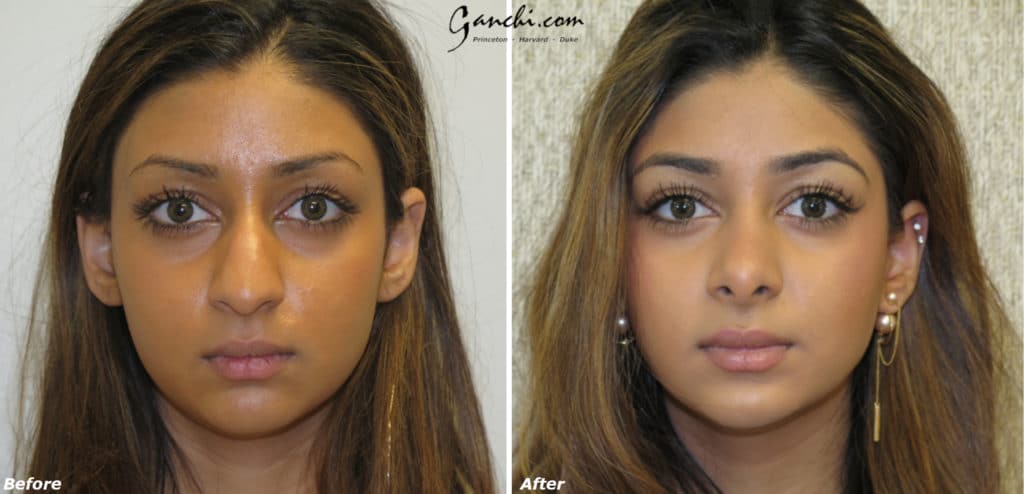 Rhinoplasty Before and After Results