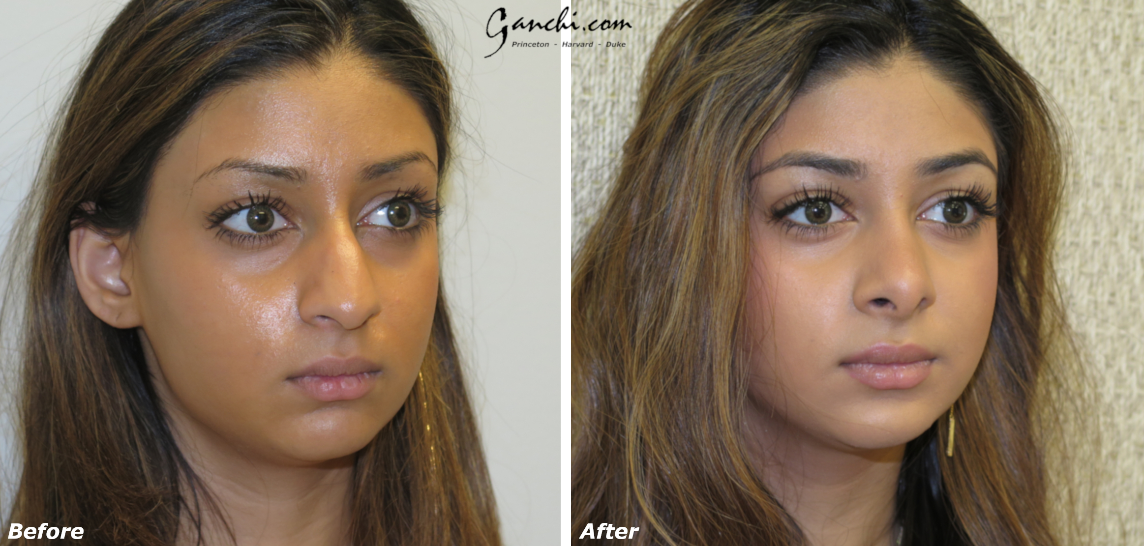 Rhinoplasty Before and After Results