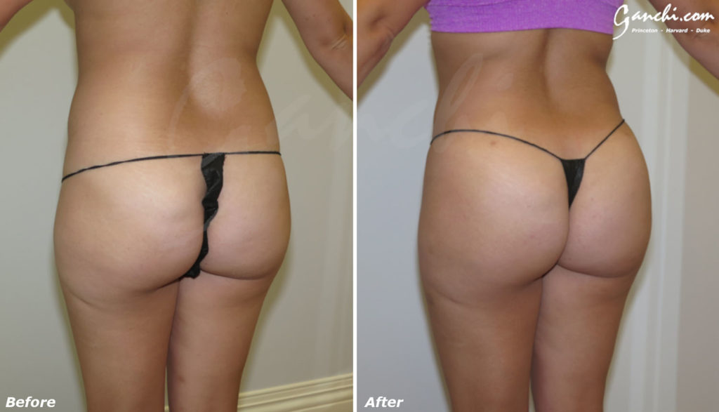 Buttock Augmentation Before and After Photo by Ganchi Plastic Surgery in Northern New Jersey